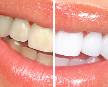 Aseta nämä liuskat hampaittesi päälle – Muutaman päivän kuluttua tulet saamaan hohtavan valkoiset hampaat