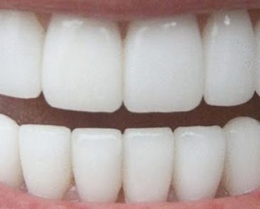 Näin saat kolmessa minuutissa hohtavan valkoiset hampaat (Toimii 100% varmuudella)