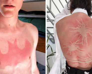 Aurinko voi olla katala tatuoija – Katso polttavat kuvat!